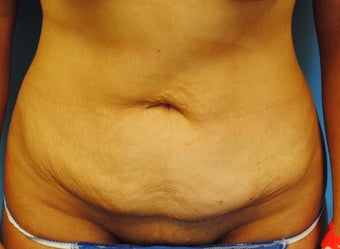 45-54 year old woman treated with Tummy Tuck before 2990109