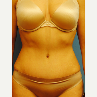 45-54 year old woman treated with Tummy Tuck after 2990109