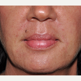 Facial Filler to Lower Face after 3374972