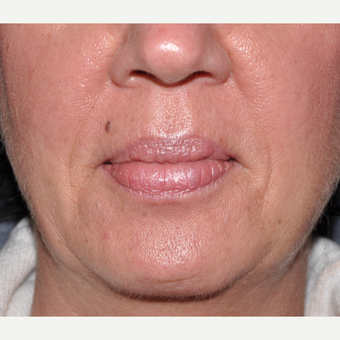 Facial Filler to Lower Face before 3374972