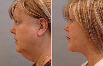 Mid Face Cheek Lift before 1360162