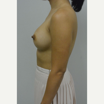 35-44 year old woman treated with Breast Implants after 3005066