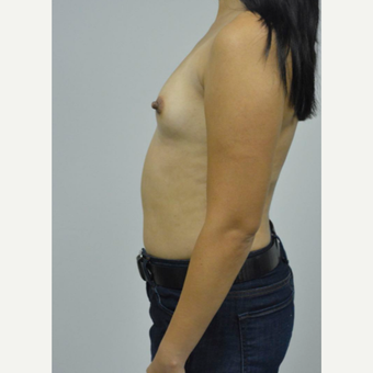 35-44 year old woman treated with Breast Implants before 3005066
