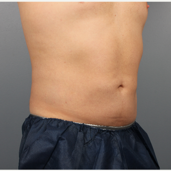 35-44 year old man treated with CoolSculpting after 3507513