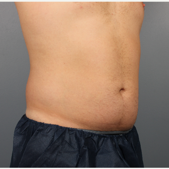 35-44 year old man treated with CoolSculpting before 3507513