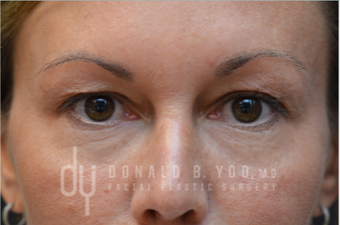 Upper Blepharoplasty before 3322720