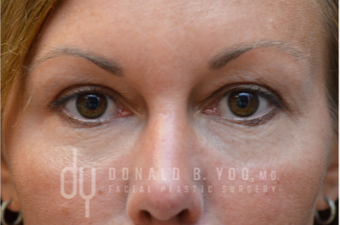 Upper Blepharoplasty after 3322720