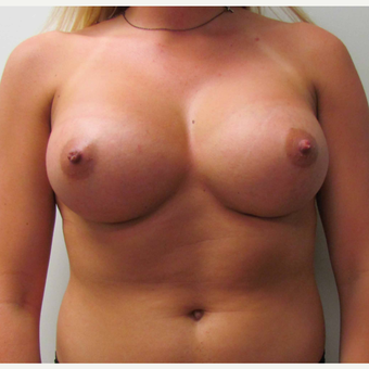 Breast Augmentation for this 6 Feet Tall 24 Year Old Woman after 3043202