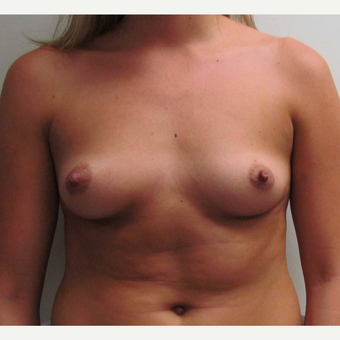 Breast Augmentation for this 6 Feet Tall 24 Year Old Woman before 3043202