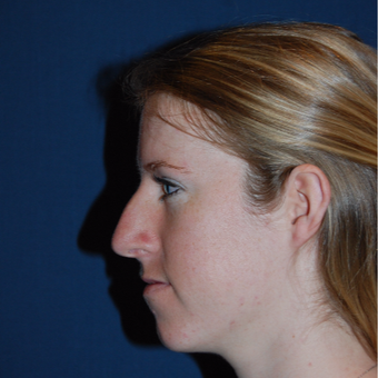 18-24 year old woman treated with Rhinoplasty before 2976847
