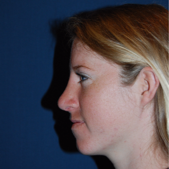 18-24 year old woman treated with Rhinoplasty after 2976847