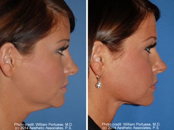 Neck Liposuction before 1389504
