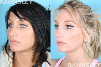 Rhinoplasty after 985203