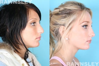 Rhinoplasty before 985203