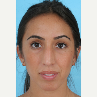 25-34 year old woman treated with Rhinoplasty before 3691138