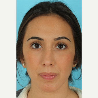 25-34 year old woman treated with Rhinoplasty after 3691138