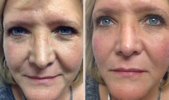 40 year old Female treated for volume loss in midface before 1229765