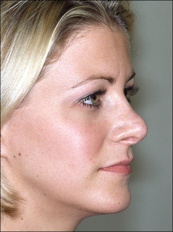 Revision rhinoplasty before 951567