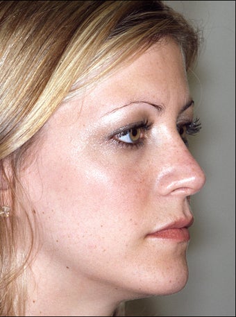 Revision rhinoplasty after 951567