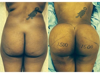 Brazilian Butt Lift using of 1500 CC of fat before 1500560