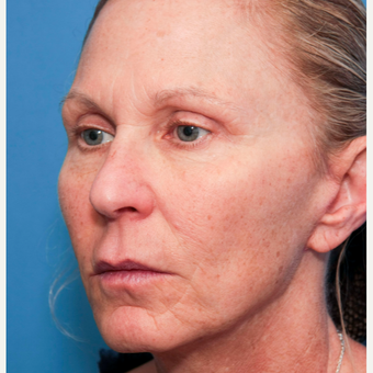 45-54 year old woman treated with Mini Lift after 3412055