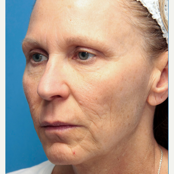 45-54 year old woman treated with Mini Lift before 3412055