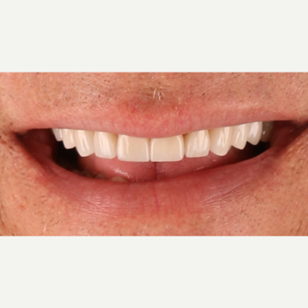 55-64 year old man treated with Porcelain Veneers after 3211796