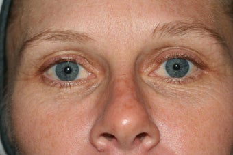 Tear trough Restylane before 1123404