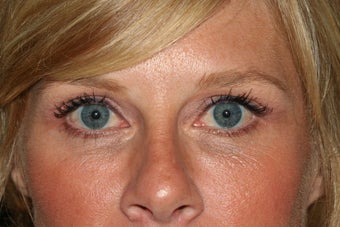 Tear trough Restylane after 1123404