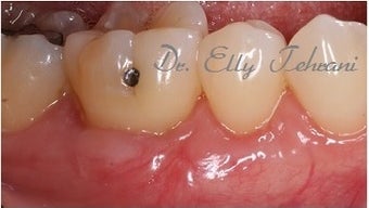 45-54 year old female treated with Gum Graft after 2618504