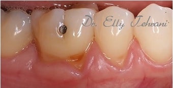 45-54 year old female treated with Gum Graft before 2618504