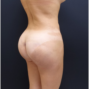 35-44 year old woman treated with Butt Augmentation after 3234500