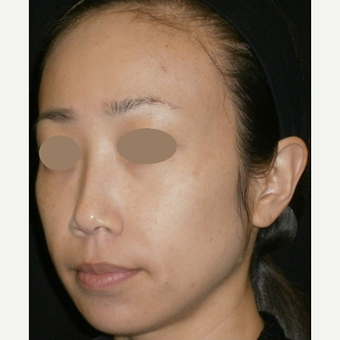 35-44 year old woman treated with IPL after 3152747