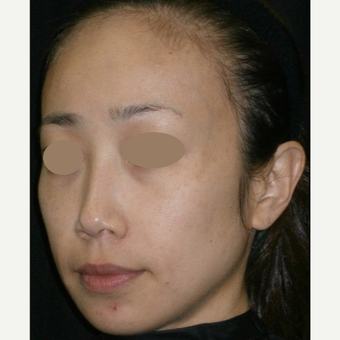 35-44 year old woman treated with IPL before 3152747