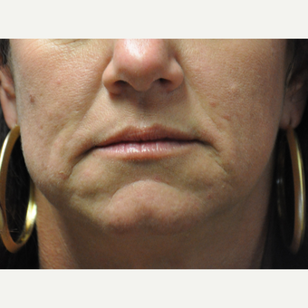 45-54 year old woman treated with Restylane before 2881432