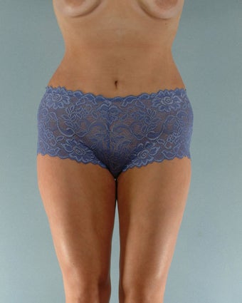 28-year old female Liposuction of Abdomen, Thighs, Flanks 1223707