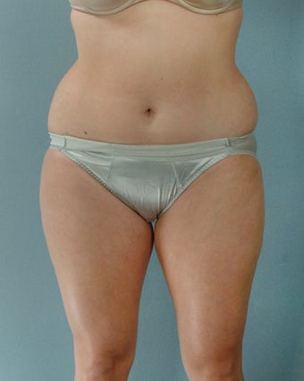 28-year old female Liposuction of Abdomen, Thighs, Flanks 1223707