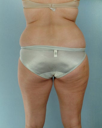 28-year old female Liposuction of Abdomen, Thighs, Flanks before 1223707