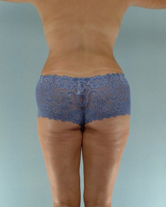 28-year old female Liposuction of Abdomen, Thighs, Flanks after 1223707