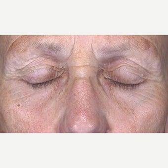 65-74 year old woman treated with CO2 Laser before 2092083