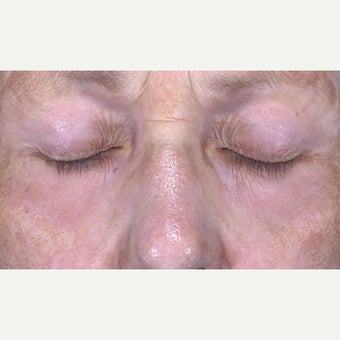 65-74 year old woman treated with CO2 Laser after 2092083