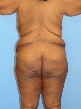 Body Lift 216784