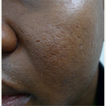African skin treated with TCA before 1764381