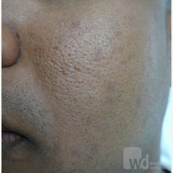African skin treated with TCA after 1764381