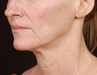 Skin Tightening for the Lower Face and Neck after 1351782