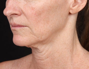 Skin Tightening for the Lower Face and Neck before 1351782