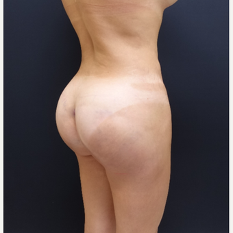 35-44 year old woman treated with 548cc Butt Implants after 3235647