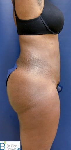 35-44 year old woman treated with Brazilian Butt Lift 3389849