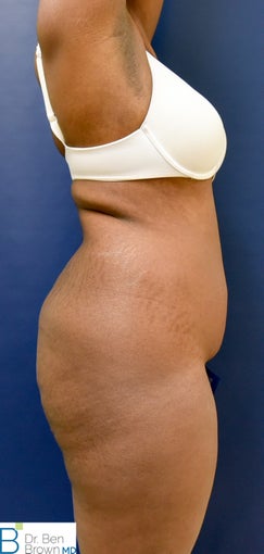 35-44 year old woman treated with Brazilian Butt Lift 3389849