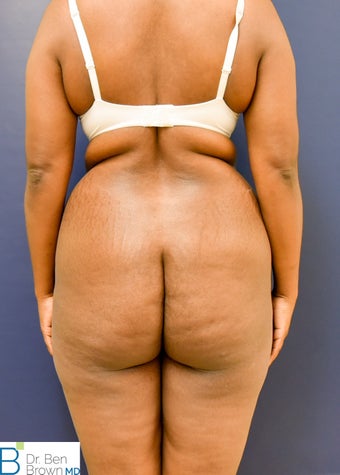 35-44 year old woman treated with Brazilian Butt Lift before 3389849